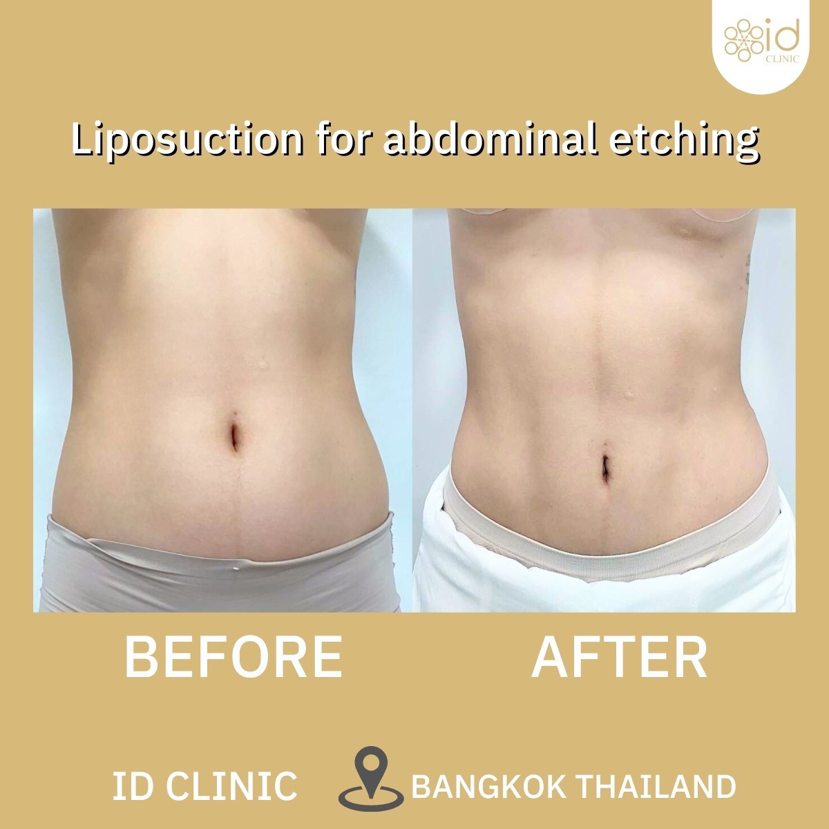 Liposuction for abdominal